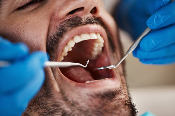 Best Emergency Dentist for Lost Fillings or Crowns in Edmond, OK